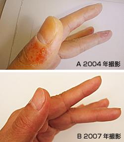 手荒れの変化